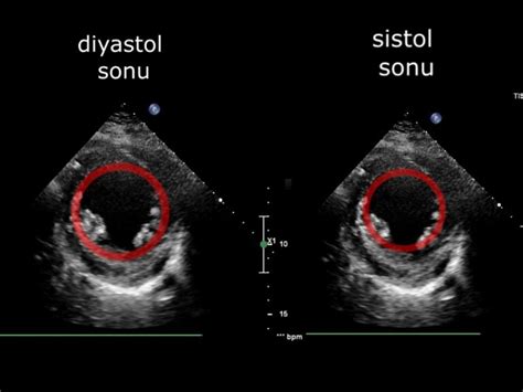 Koroner arter hastalarında sol ventrikül bölgesel sistolik .